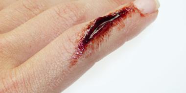 порез пальца