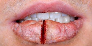 расщепленная губа